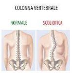 scoliosi