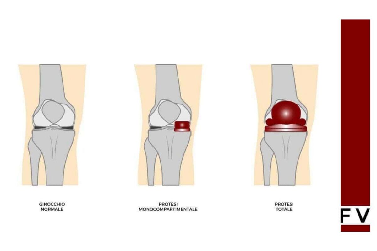 protesi parziale ginocchio